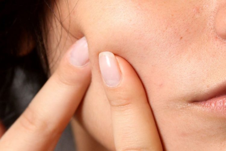 acné en personas adultas